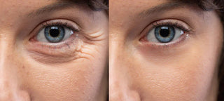 Kit Microneedling professionnel sans fil + Acide Hyaluronique Stérile