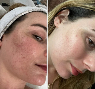 Kit Microneedling professionnel sans fil + Acide Hyaluronique Stérile