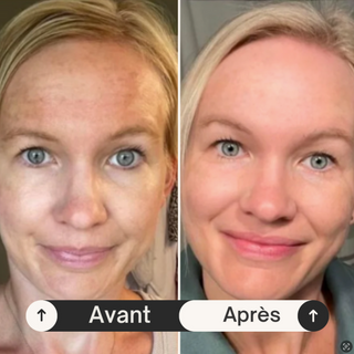 Kit Microneedling professionnel + Acide Hyaluronique Stérile