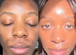 Kit Microneedling professionnel + Acide Hyaluronique Stérile