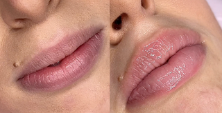 Kit Microneedling professionnel + Acide Hyaluronique Stérile
