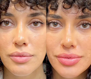 Kit Microneedling professionnel + Acide Hyaluronique Stérile